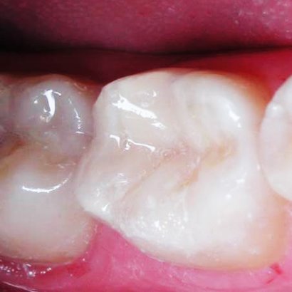 plombirovanie-zubov-plastmassa.jpg