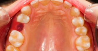 Шатание зубов причина лечение