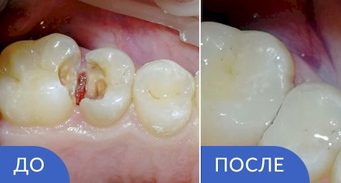 Кариес зубов