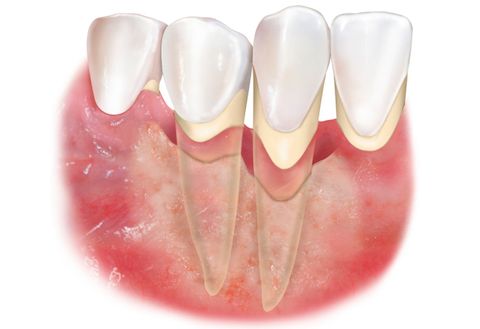 Как выглядит пародонтит фото