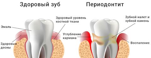 Периодонтит