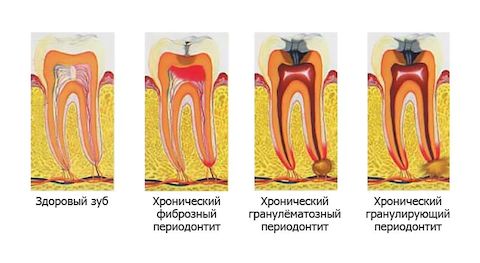 Периодонтит
