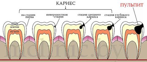 Клиническая картина остаточного пульпита