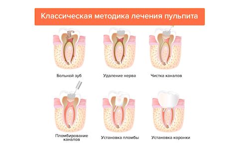 Пульпит Пульпит