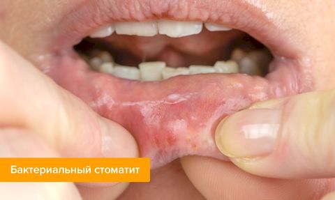 Стоматит Стоматит