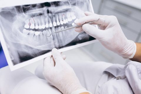 Рентген в стоматологии | НАВА