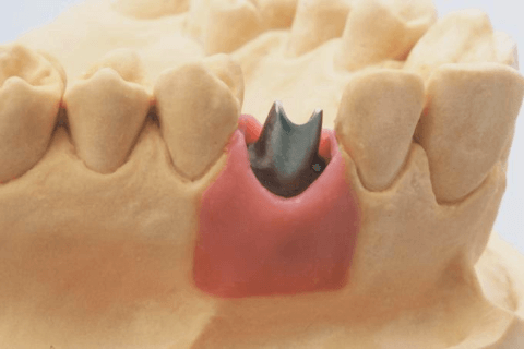 индивидуальный абатмент в имплантаций зубов