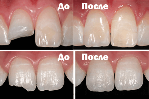 Реставрация цвета зубов до и после