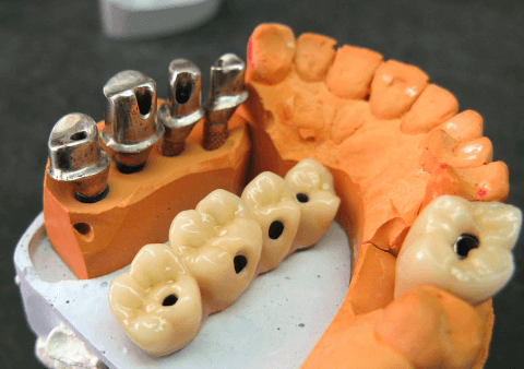фрезеровка абатмента фронтального зуба