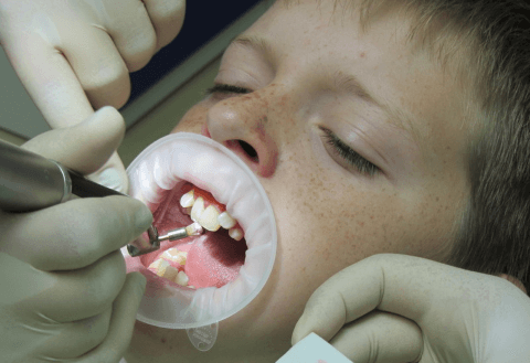 Герметизация фиссур молочных зубов