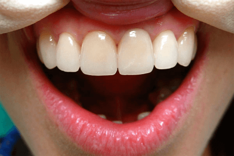 металлокерамическая коронка на зуб