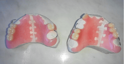срочный ремонт зубных протезов в москве