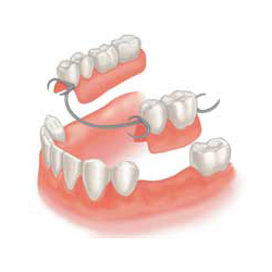 зубные протезы, протезирование, мостовидный протез