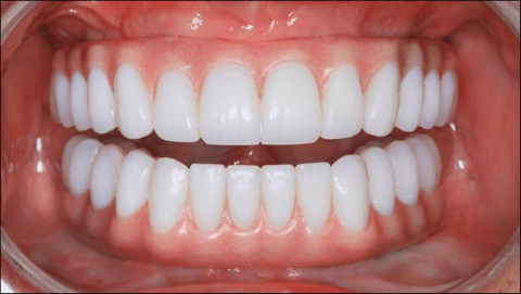 съемный зубной протез