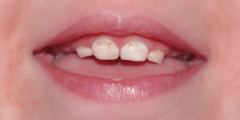 Серебрение молочных зубов Томск Братская Сложное удаление зуба Томск Королева