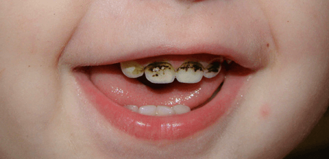 что такое серебрение молочного зуба