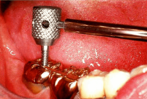 снятие зубной коронки