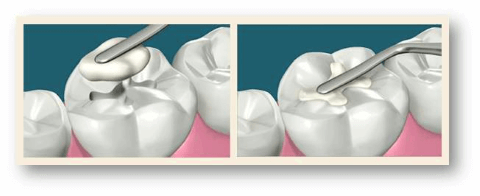 Снятие пломбы с зуба