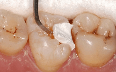 снятие пломбы без распломбирования зуба