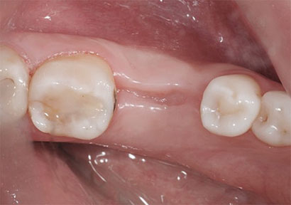 Чем можно полоскать рот после удаления зуба - чем и когда полоскать - инструкция