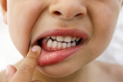 Ретенция зубов - Разновидности | Устранение аномалии - центр стоматологии «Тихонова» в Туле