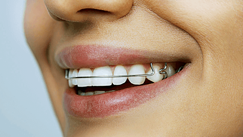 Ортодонтические пластины