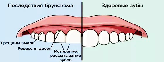 pochemu-rebenok-skripit-zubami-vo-sne1