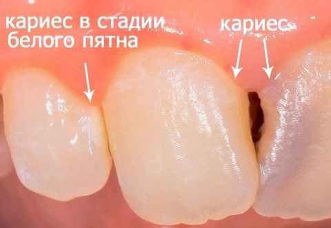 Кариес зубов виды