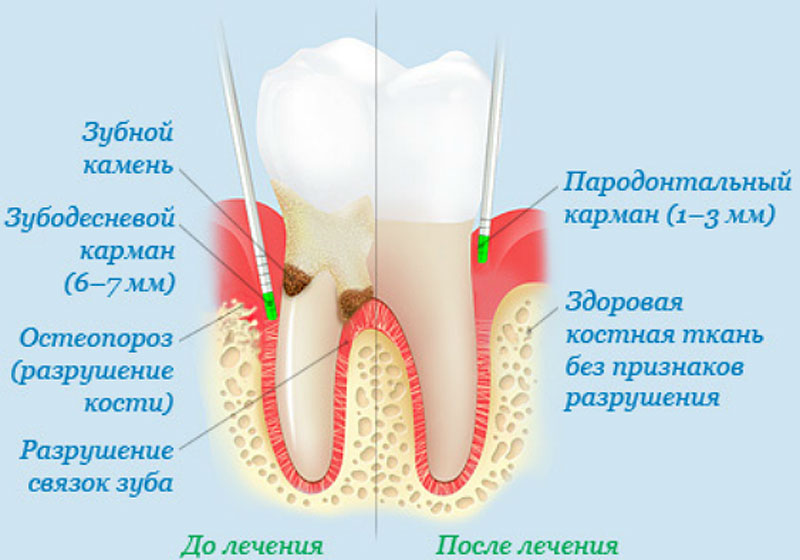 zakrytyj-kyuretazh-parodontalnyh-karmanov1