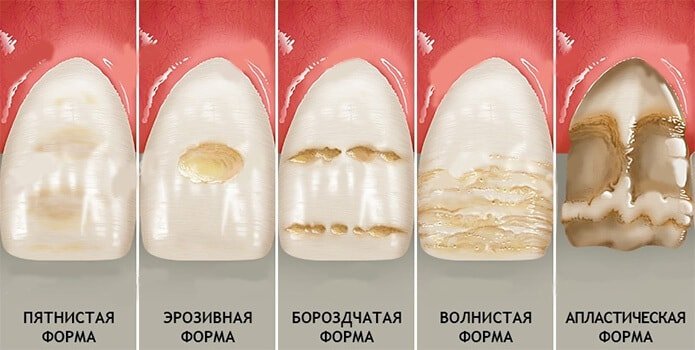 vosstanovlenie-emali-zubov1