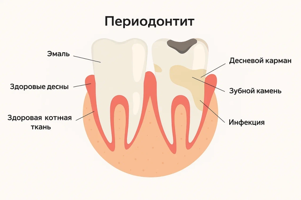 Лечение периодонтита