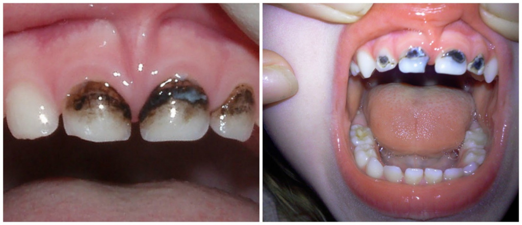 Детская стоматология с наркозом