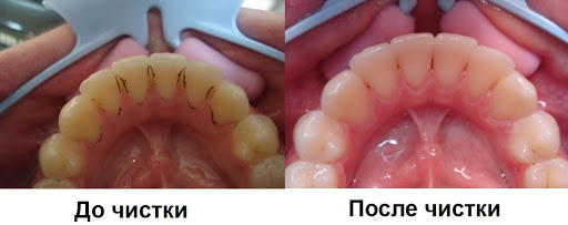 ultrazvukovaya-chistka-zubov1